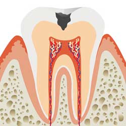 C2:中期　象牙質の虫歯