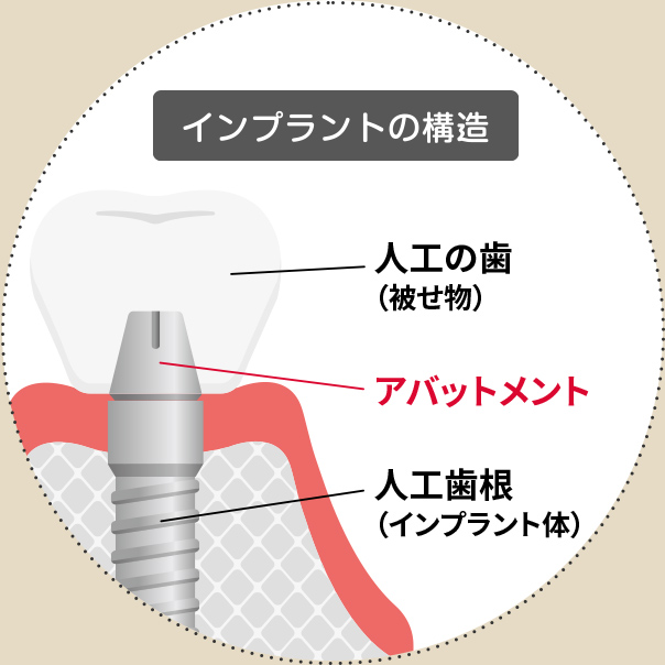 アバットメントとは