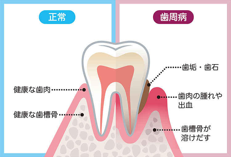 歯周病とは