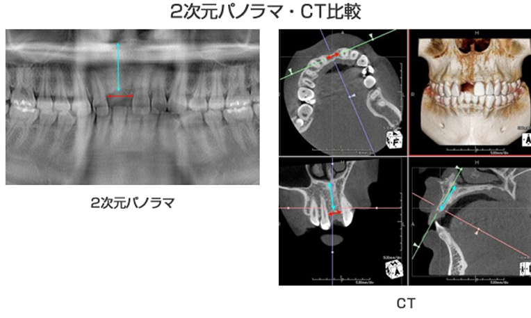 従来の２次元パノラマと歯科用CTとの比較