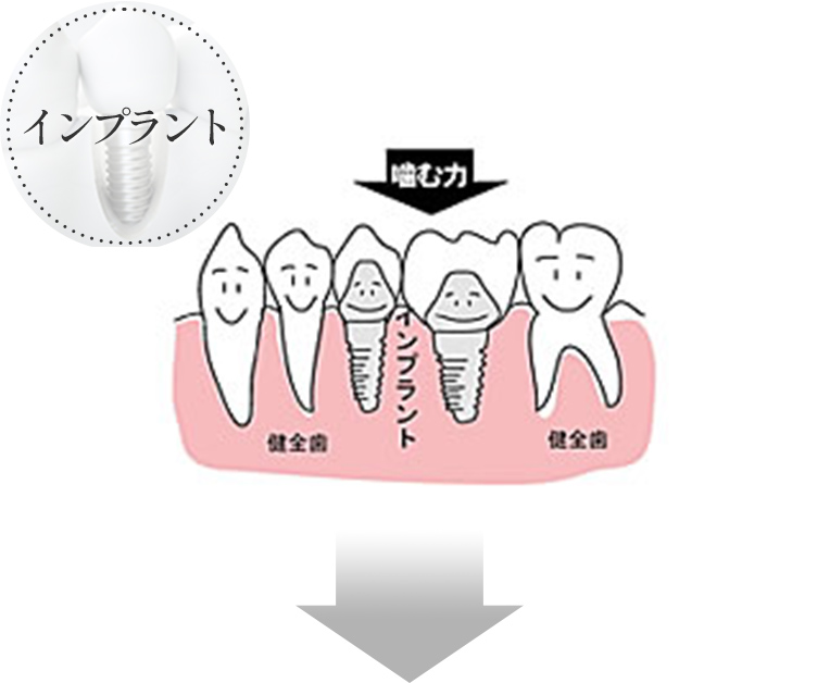 インプラント