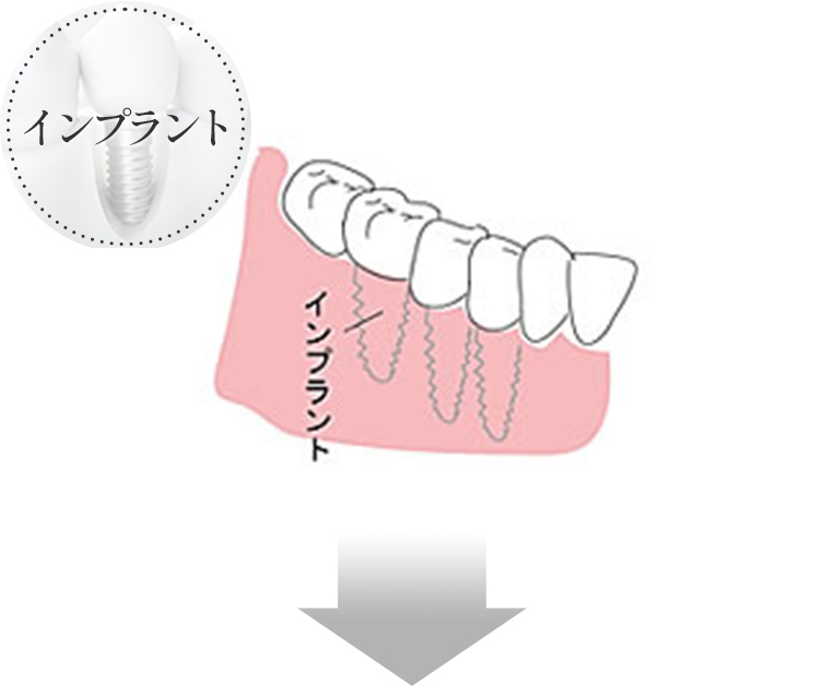 インプラント