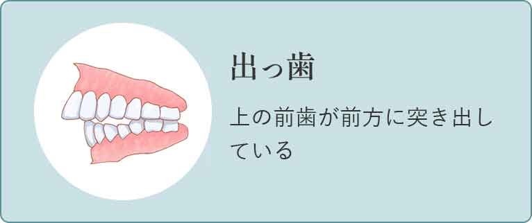 出っ歯