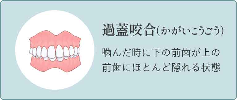 深い噛み合わせ