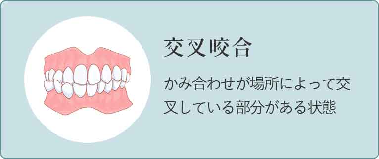 深い噛み合わせ