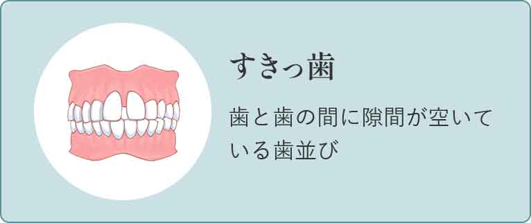 受け口