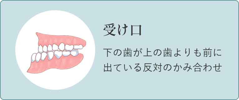 受け口