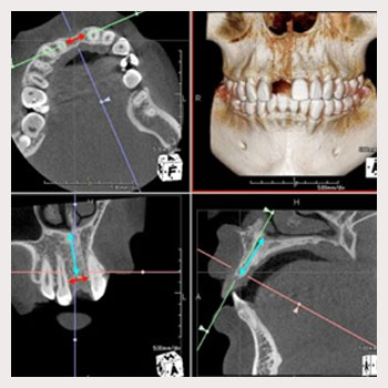 歯科用CT