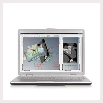 DTX Studio Implant
