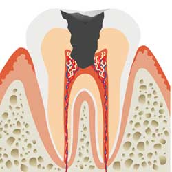 C3:後期　神経まで進行した虫歯