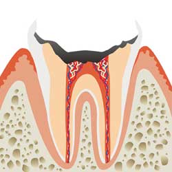 C4:末期　神経まで進行した虫歯