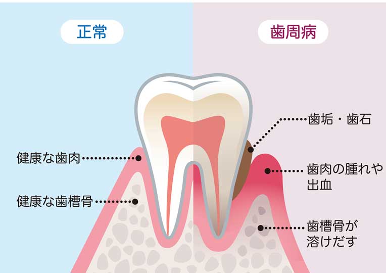 歯周病