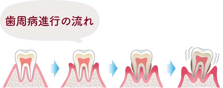 歯周病の進行度