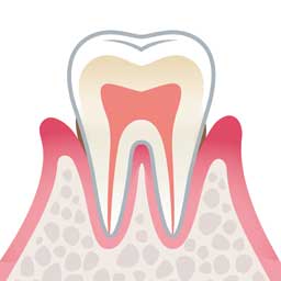 軽度歯周炎
