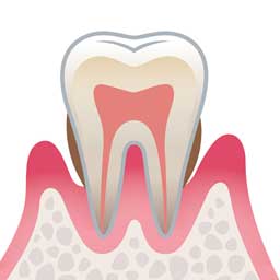 中等度歯周炎