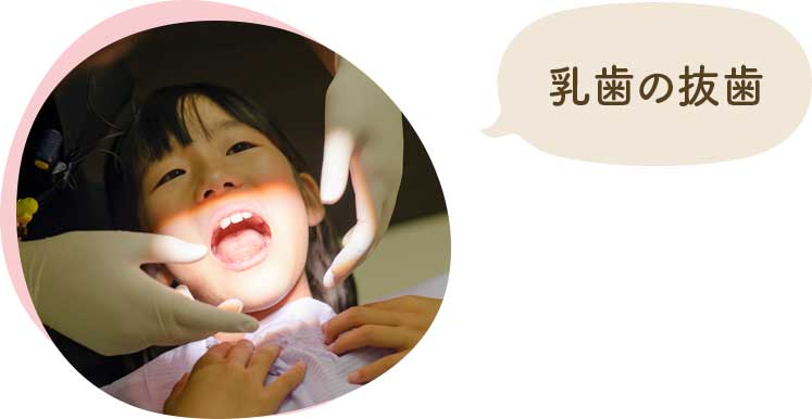 乳歯の抜歯