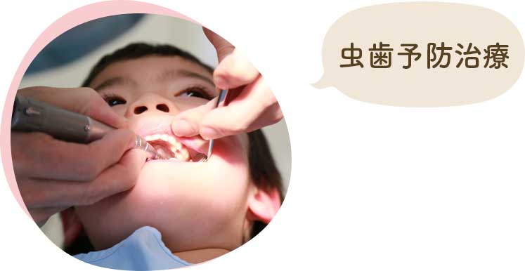 虫歯予防治療
