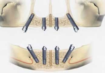 All-on-4によるインプラントの配置と4本のインプラントを埋め込んだ状態