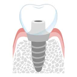 インプラント治療において