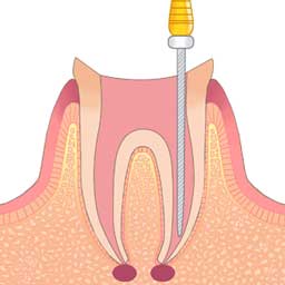 根管治療において