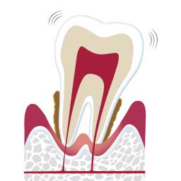 歯周病治療において