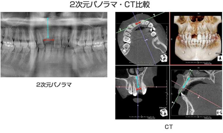 親知らずを抜く場合