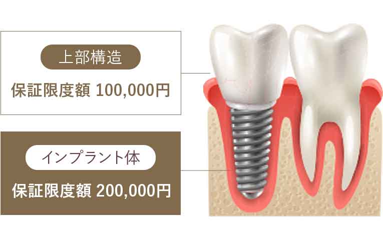 ガイドデント保証システム