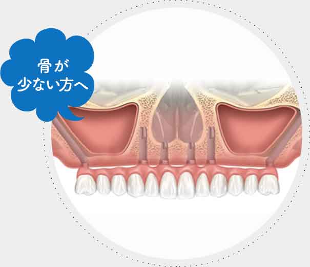 ザイゴマインプラント