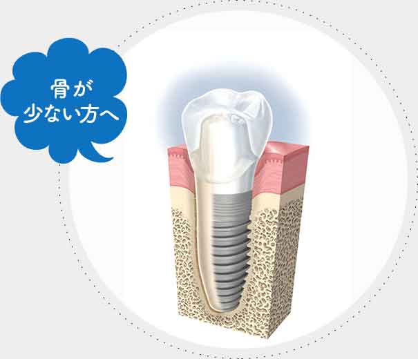 骨造成手術