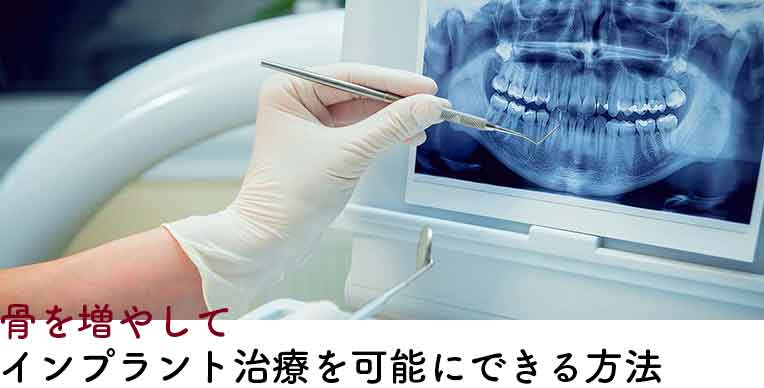 骨が足りなくてもインプラント治療を可能にする方法