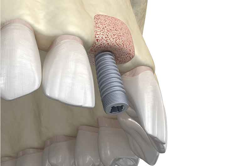 ソケットリフト:上あごの骨が薄い時に行う方法