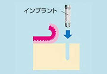 1次手術(埋入手術～その2～)