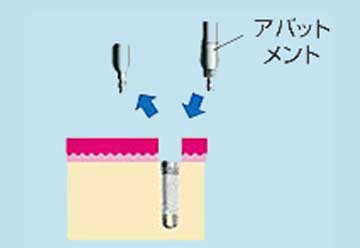 アバットメントに取り替える